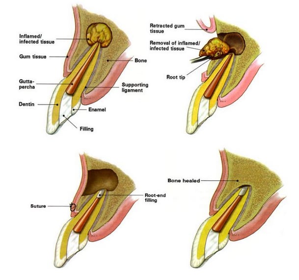 Apicoectomy root-end surgery diagram showing surgical procedure steps
