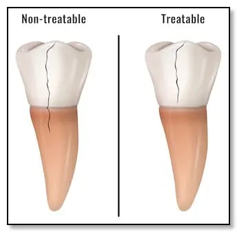 Cracked tooth comparison showing treatable vs non-treatable cracks