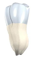 Different types of tooth cracks and fractures requiring endodontic treatment