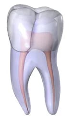 Fractured Cusp - dental crack type showing moderate damage