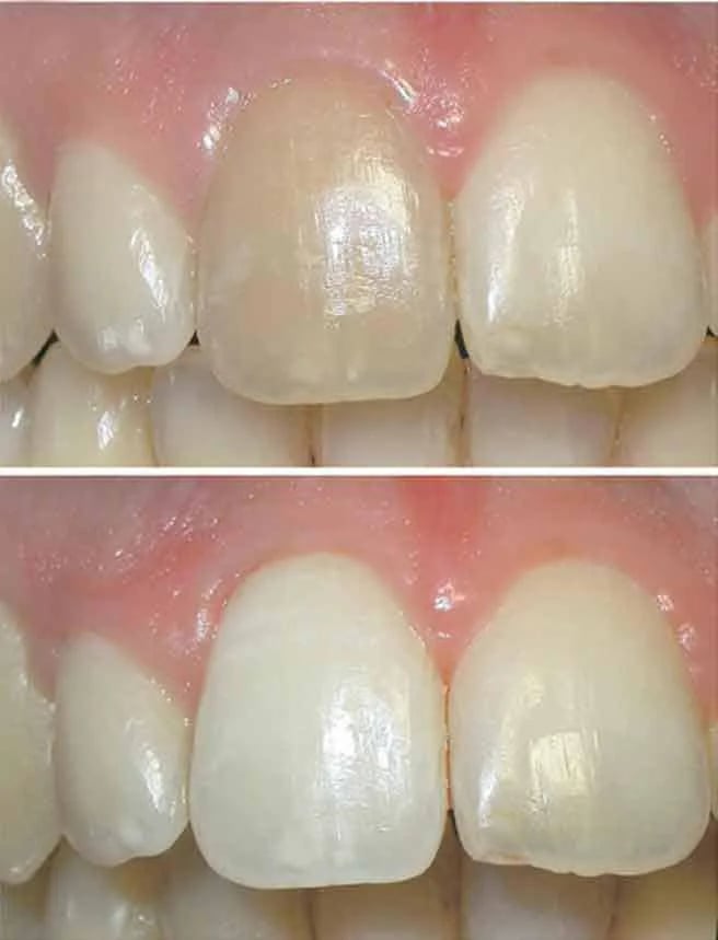 Internal bleaching procedure showing the step-by-step process for tooth whitening after root canal treatment