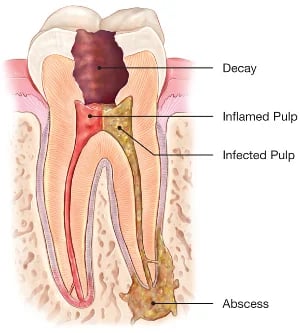 Dental X-ray showing infected tooth pulp requiring root canal therapy treatment