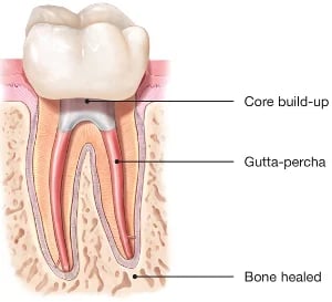 Successful root canal therapy result showing healed tooth structure after endodontic treatment in Issaquah