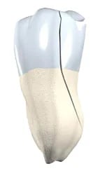 Split Tooth - dental crack type showing severe damage