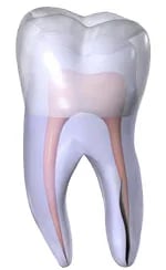 Vertical Root Fracture - dental crack type showing critical damage