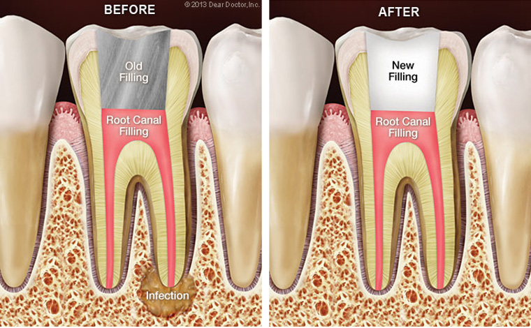 Root canal retreatment procedure showing before and after X-ray comparison of failed and successful endodontic treatment